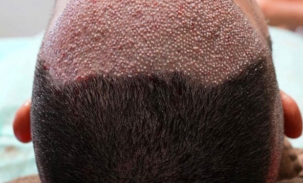 Yaz Ayında Saç Ekimi Yapılır mı?